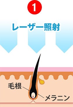 レーザーを毛根に照射